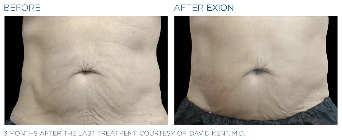 Exion pic ba card abdomen male 019 body enus100