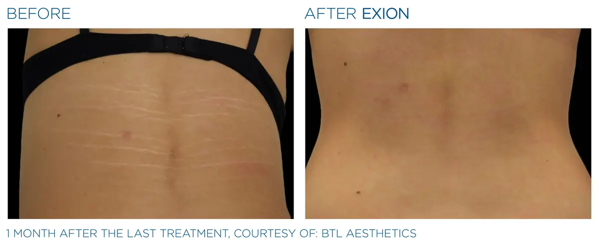 Exion pic ba card back female 024 frf enus100