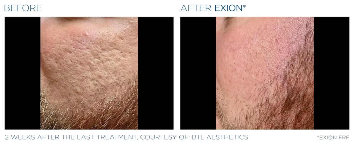 Exion pic ba card cheek male 010 frf enus100