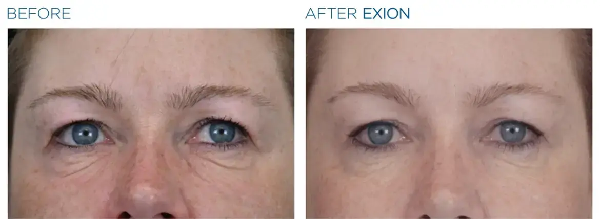 Exion face before and after 2 contour room sherman oaks ca copy