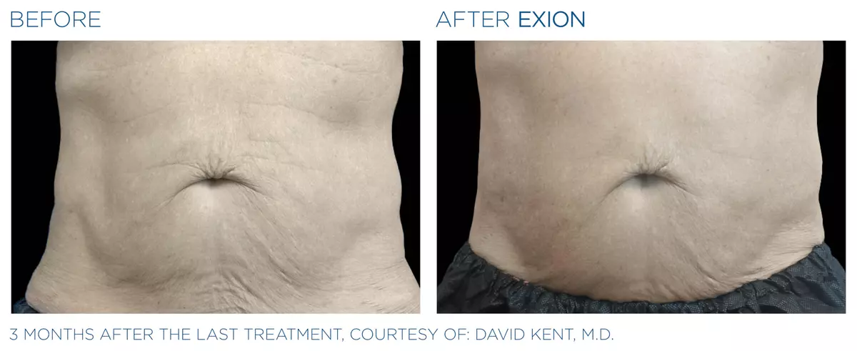 Exion pic ba card abdomen male 019 body enus100