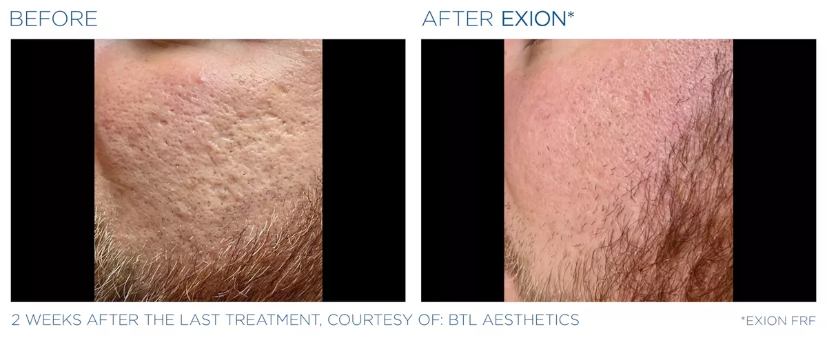 Exion pic ba card cheek male 010 frf enus100