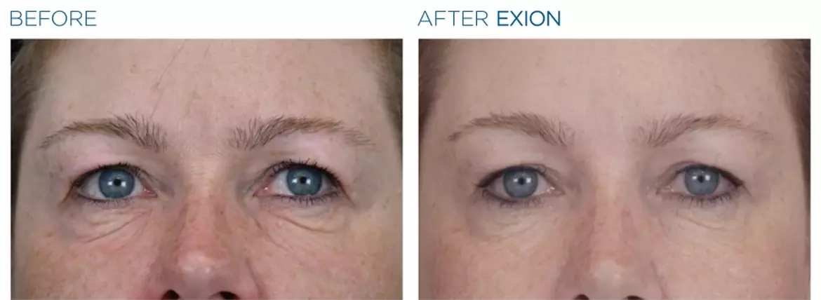 Exion face before and after 2 contour room sherman oaks ca copy